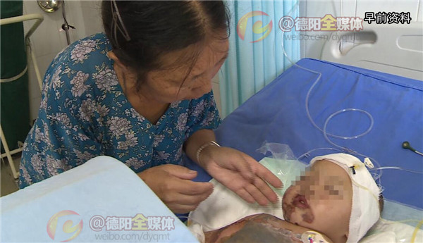 19岁烧伤女孩小玲出院啦,烧伤女孩小玲最新消息