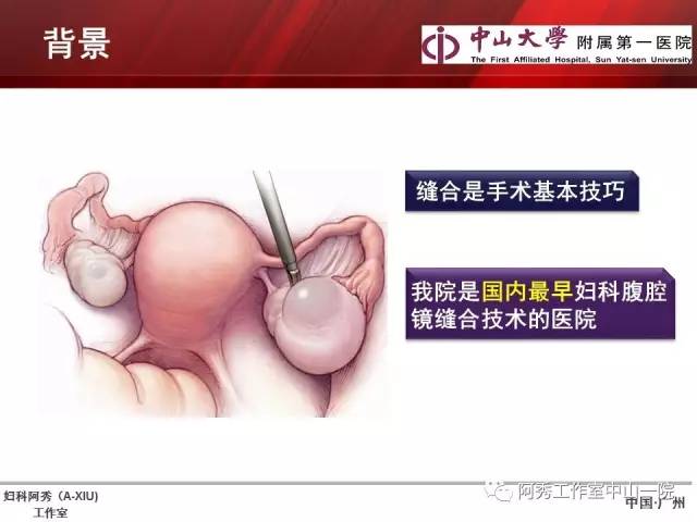 妇科腹腔镜下常用缝合技巧