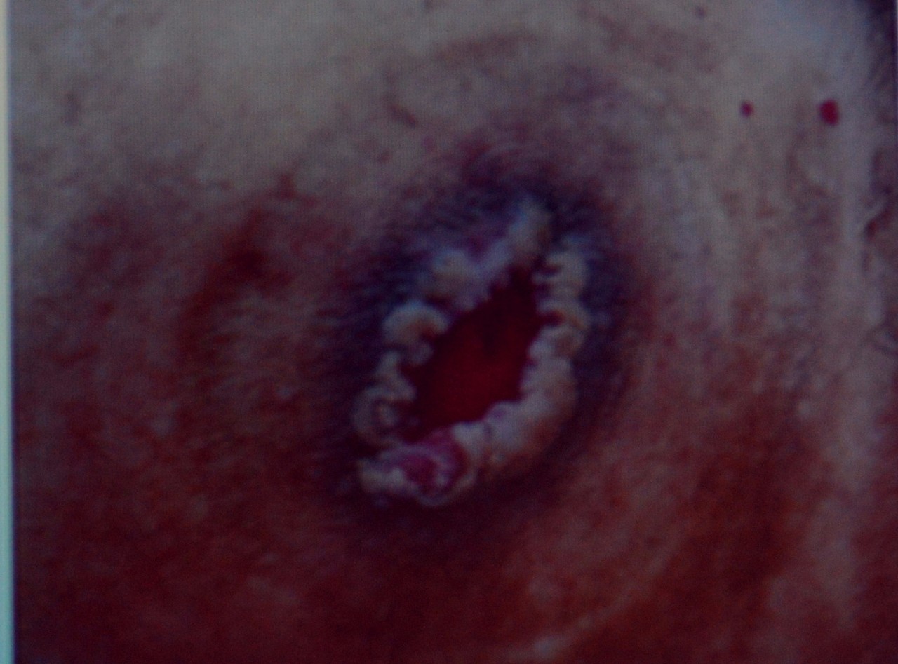 肠造口回纳的并发症是什么,膀胱全切肠造口有什么并发症