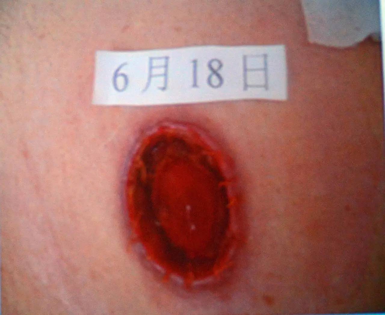 肠造口回纳的并发症是什么,膀胱全切肠造口有什么并发症