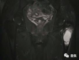 髋部疼痛做什么检查,左髋部疼痛待查病例