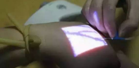 扎针如何进针不疼,怎么扎针最稳不鼓