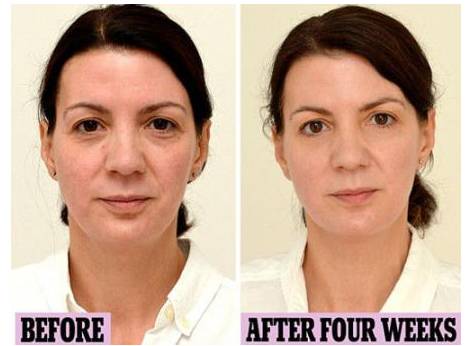 皮肤干燥长斑长痘用什么做面膜好,脸色暗沉有痘印如何护肤效果好