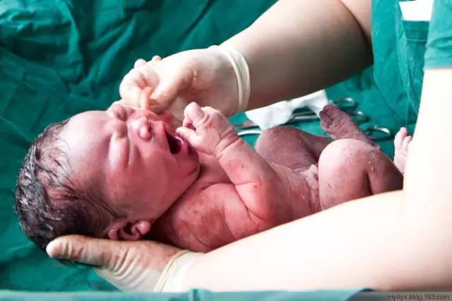 剖腹产全景记录,剖腹产恢复不同时期的照片