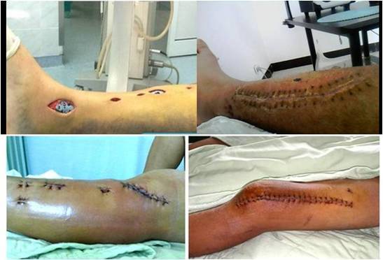 骨折复位后局部断端成角,骨折断端稍错位能恢复吗