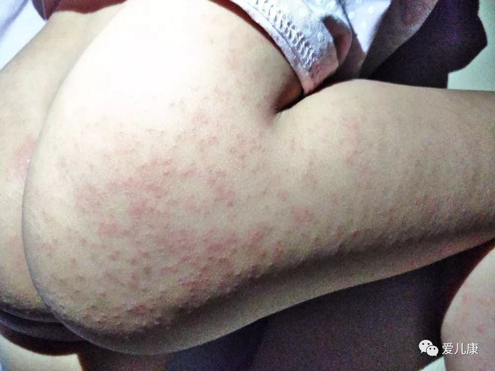 专家在线丨宝宝全身出红痘,医生说与孩子吃了这三样东西有关……