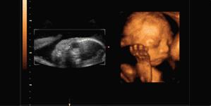 检查b超结果显示宫内早孕,检查b超还是阴超好