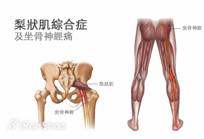 训练后髋关节痛怎么办,训练跑步小腿痛怎么回事