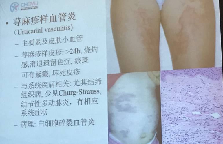 幼儿麻疹的鉴别方法,儿童麻疹的诊断与治疗