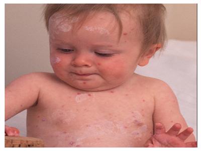 水痘有哪些症状和特征,水痘的主要特点是