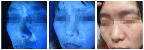 治疗白癜风外用药有哪些,白癜风外用药副作用