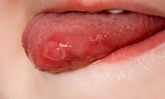 反复口腔溃疡要做什么检查,反复发作口腔溃疡开刀