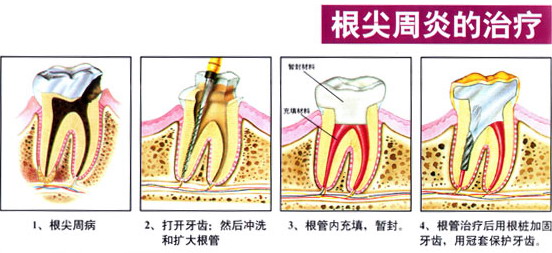 坐飞机牙疼怎么缓解,坐飞机牙痛是怎么回事