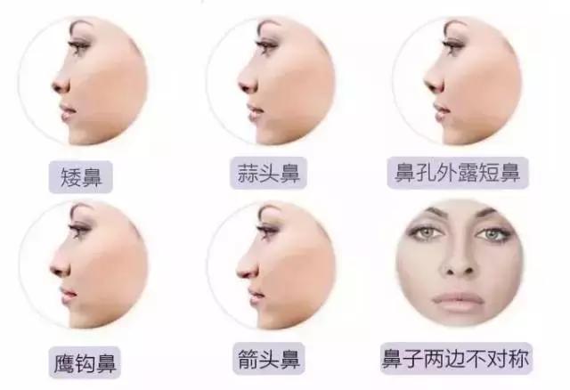 鼻子不好看的女性,线雕鼻做好鼻梁太细是什么原因