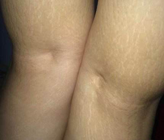 胖子肚子上的纹路怎么消,肥胖肚子上有斑点