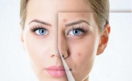 长痘痘可以做激光祛痘吗,激光祛痘有哪种仪器