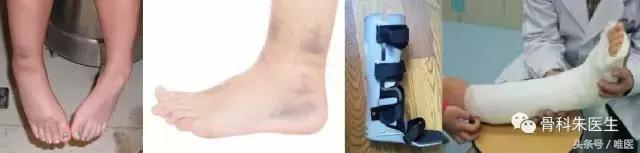 骨科脚踝扭伤怎么快速恢复,医生会怎么处理脚踝扭伤