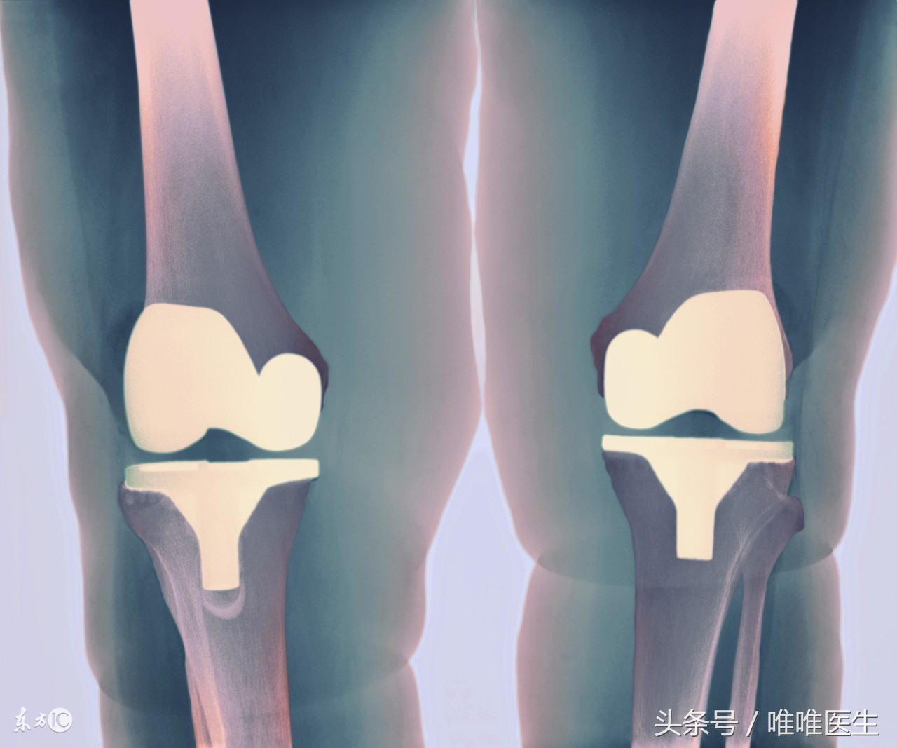 专家支招科学应对骨关节炎,更年期骨关节炎预防和治疗