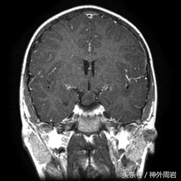 痴笑癫痫发作时会怎样,痴笑性型癫痫病发作是什么感觉