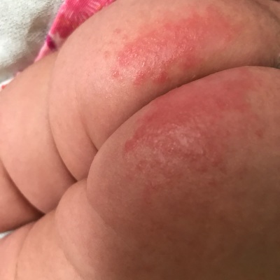 宝宝腹泻别着急三招教你轻松应对,宝宝腹泻的十大危害