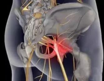 腰椎突出压迫坐骨神经痛怎么治疗,坐骨神经痛单侧屁股痛怎么治疗呢