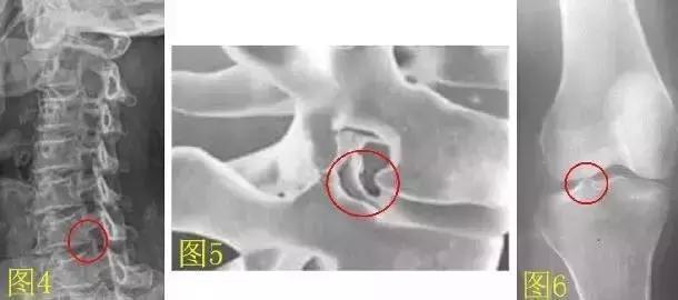 骨刺增生的保健品,药品的宣传可以消除骨刺是真的吗