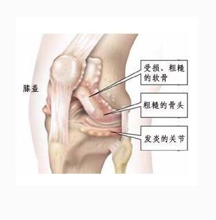 膝盖滑膜炎5天自愈方法,小儿膝盖滑膜炎一般多久能自愈