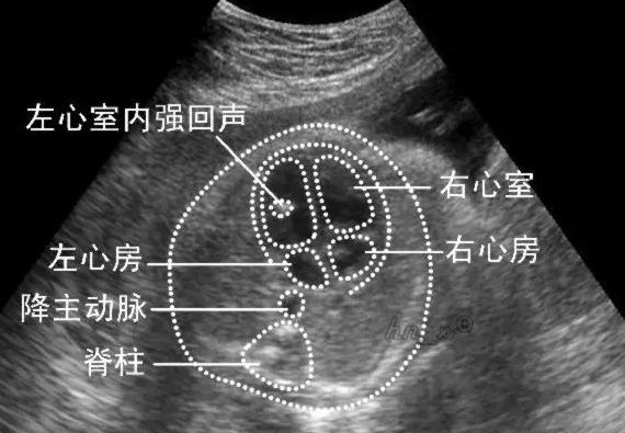 胎儿心脏b超有强光点,为啥胎儿心脏会出现强光点
