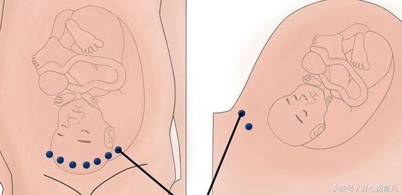 产后小课堂：顺产和剖宫产的伤口护理知识大全，让你轻松坐好月子