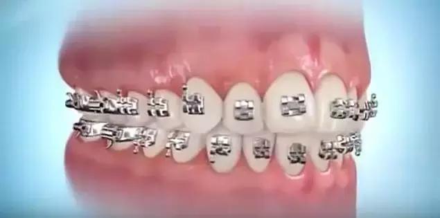 箍牙的牙套是怎么固定上去的,箍牙齿全过程图片