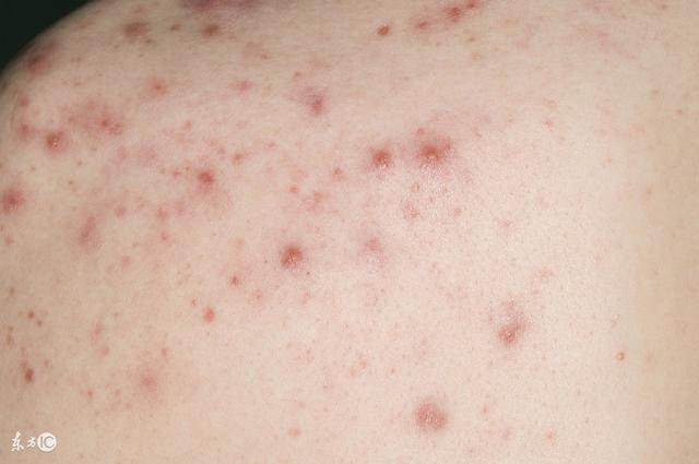 丘疹怎么调理饮食,丘疹的正确消除方法