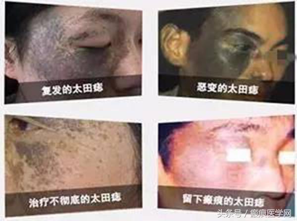 这么多年，还在和太田痣纠缠不清！