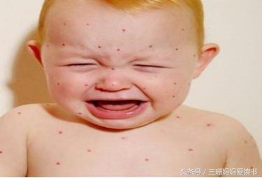 宝宝荨麻疹过敏反复起红疹怎么办,宝宝过敏引起的急性荨麻疹