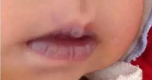 嘴唇变紫是心脏病吗,嘴唇变色是什么原因引起的