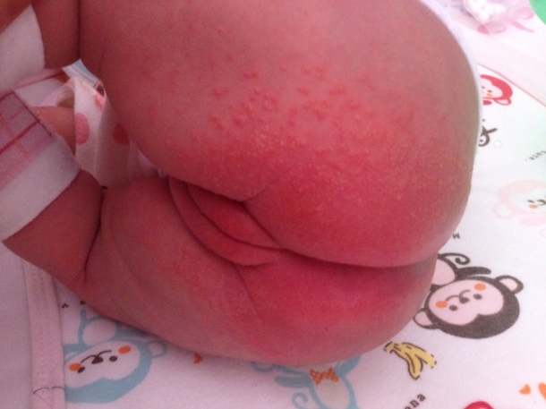 脾虚湿盛型湿疹小儿推拿穴位,小儿推拿后起湿疹是排毒反应吗