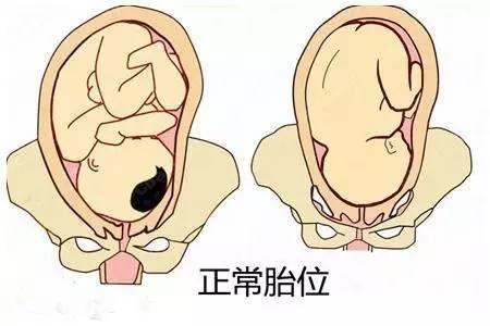 几种胎位不正需要剖腹产,正确胎位和臀位