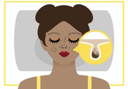 12岁孩子脸上黑头粉刺如何处理,男士脸上黑头粉刺怎么去除