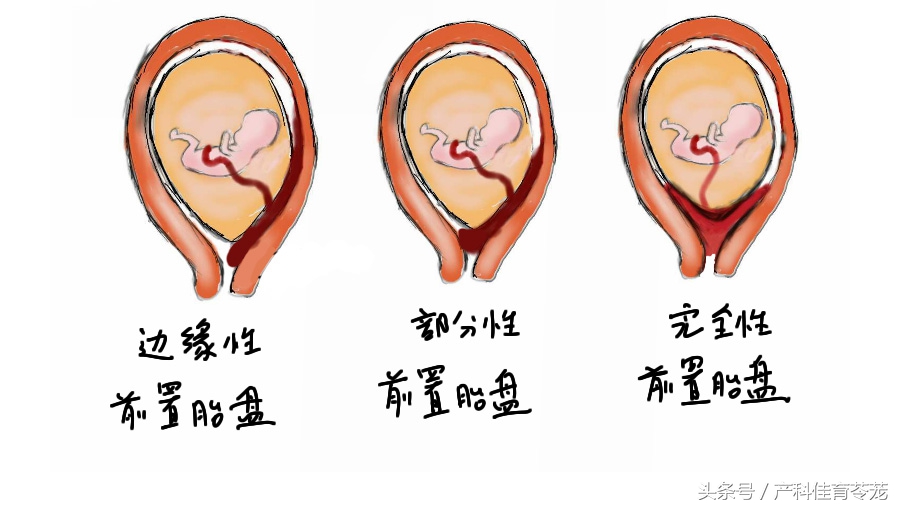 胎盘位置解析,胎盘位置由什么决定