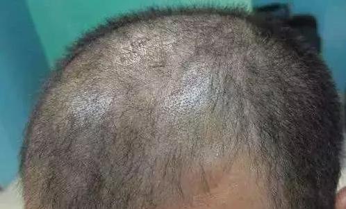 治疗脱发几大误区你有吗,治脱发吃半个月药无效