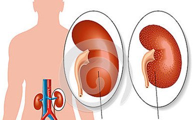 肾病高血压降压标准,慢性肾病如何降压