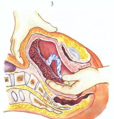 孕妇顺产徒手剥离胎盘,孕妇分娩后手剥胎盘