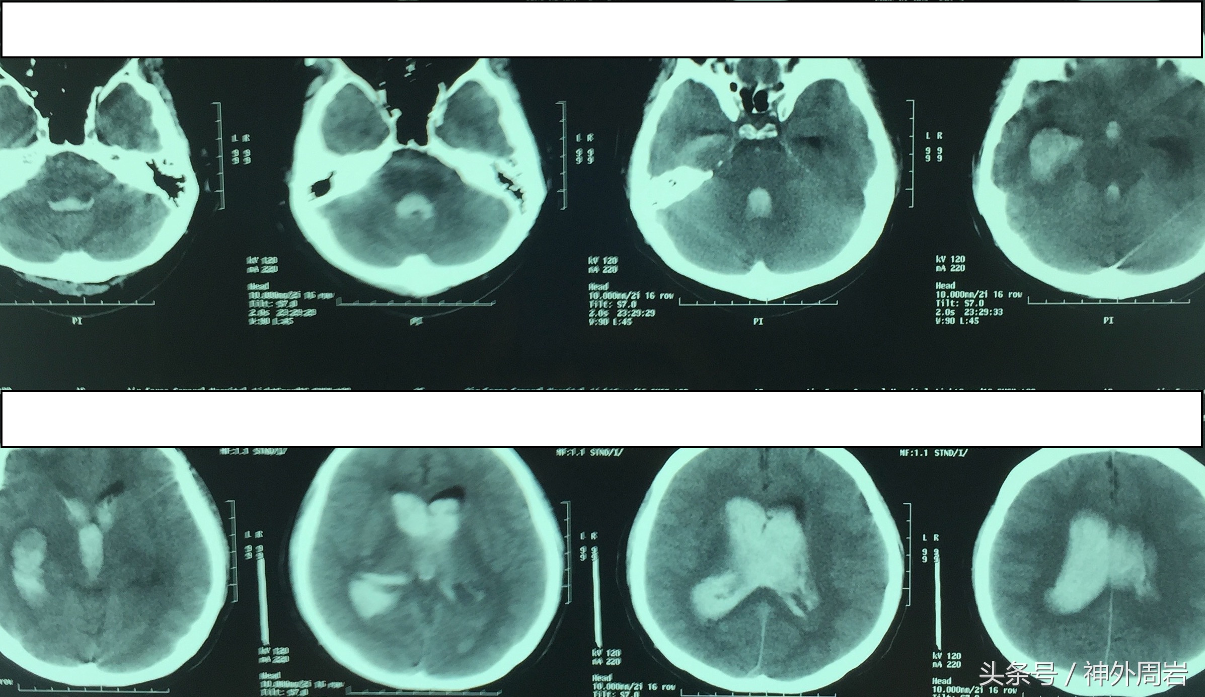烟雾病脑内出血,烟雾病脑室出血死亡率