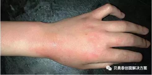 烧伤深度与临床表现图,氢氟酸烧伤的临床表现