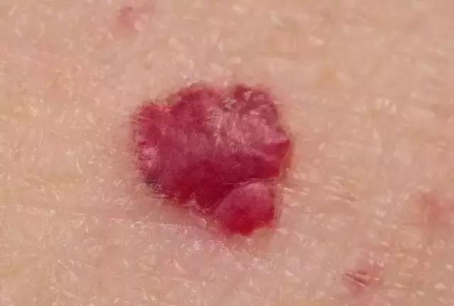 省̥妇̥幼̥专家提醒，宝宝出生有这些印记，一定要去！医！院！