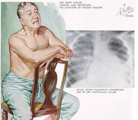 深海鱼油对老年痴呆有用吗,深海鱼油能预防心脑血管疾病吗