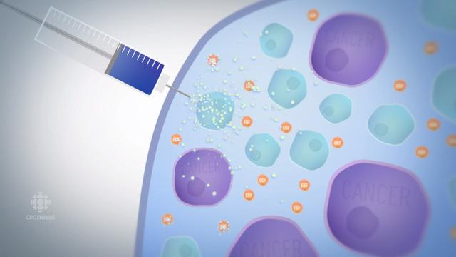 古巴治疗肺癌晚期,古巴肺癌晚期治疗