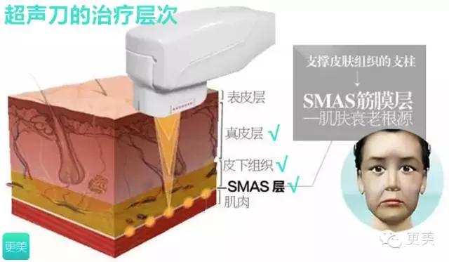 超声疑惑大揭秘,超声刀七大注意事项你都知道吗