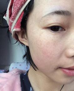 妈妈为女儿消脸上疤,妈妈为了孩子不容易