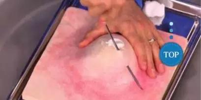 如何挤痘痘才是正确的方法,手把手教你挤痘痘