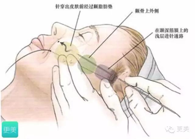 埋线美容线和不吸收线有什么区别,医院埋线和美容院埋线有什么差别